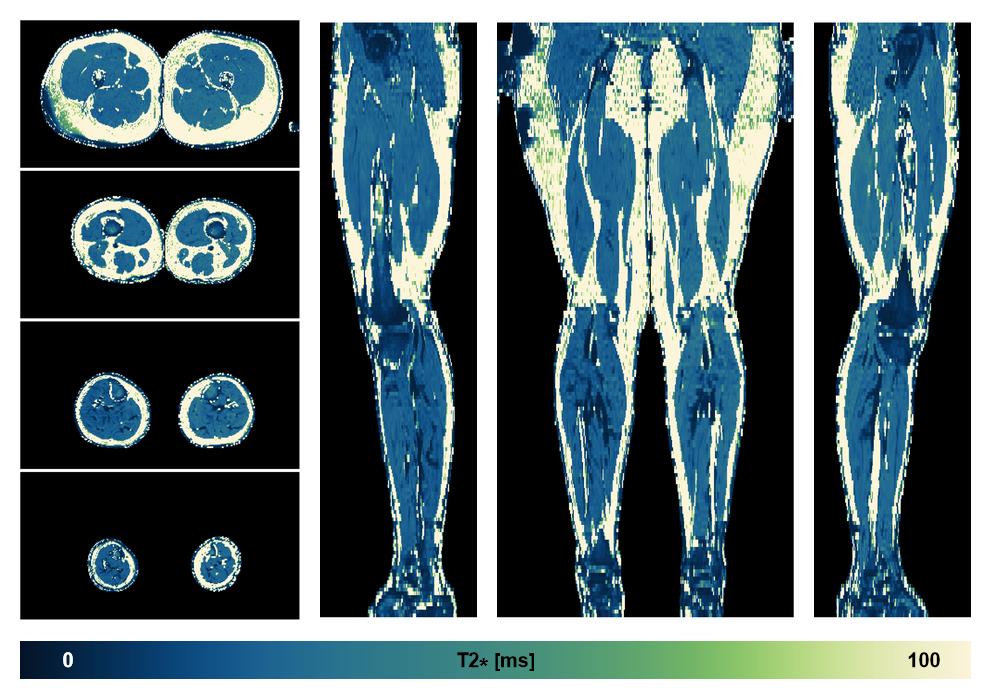 The T2 star relaxation time of the lower extremity obtained from the dixon reconstruction for muscle water fat quantification.